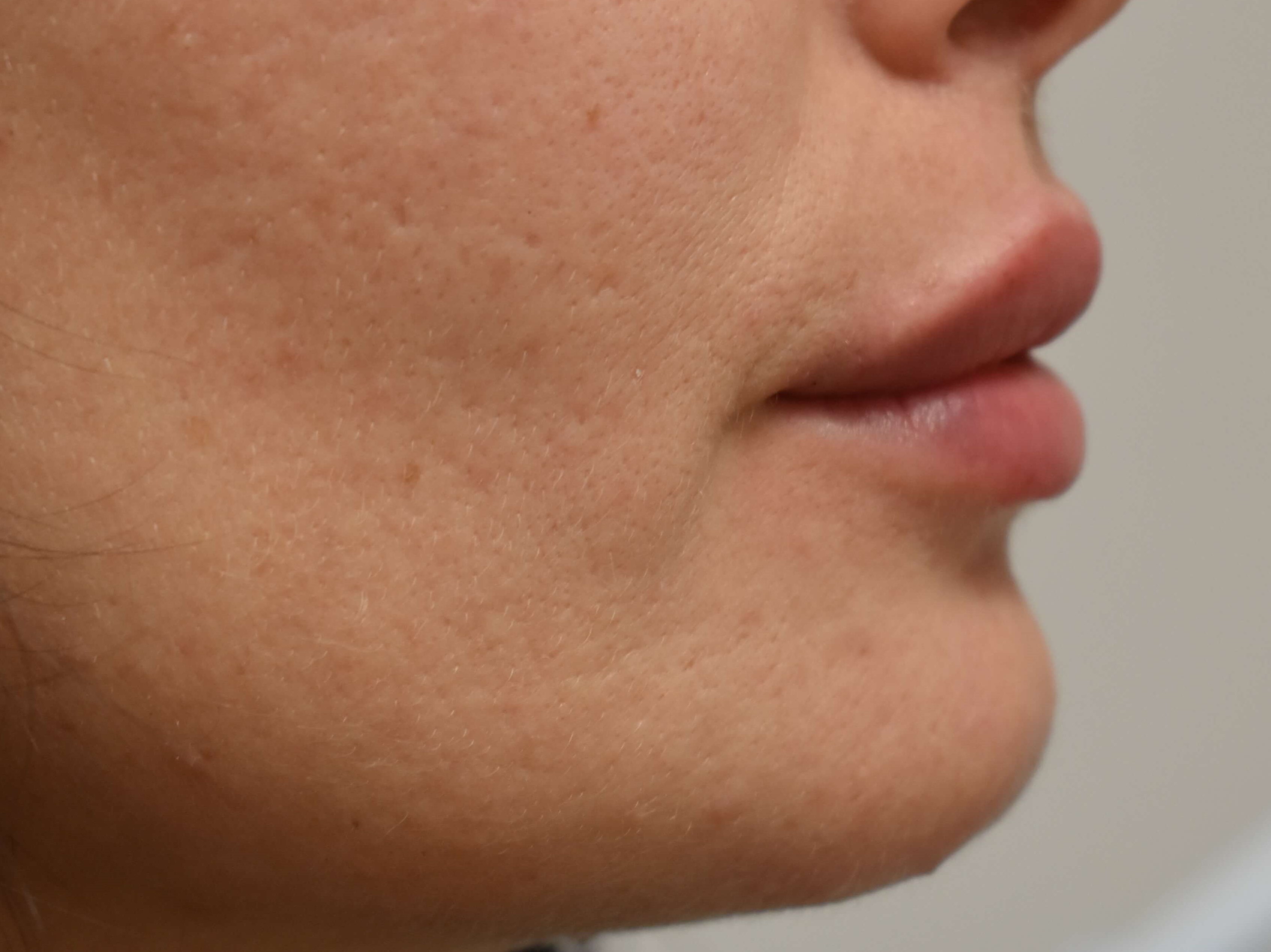 Lip Filler Before and After After