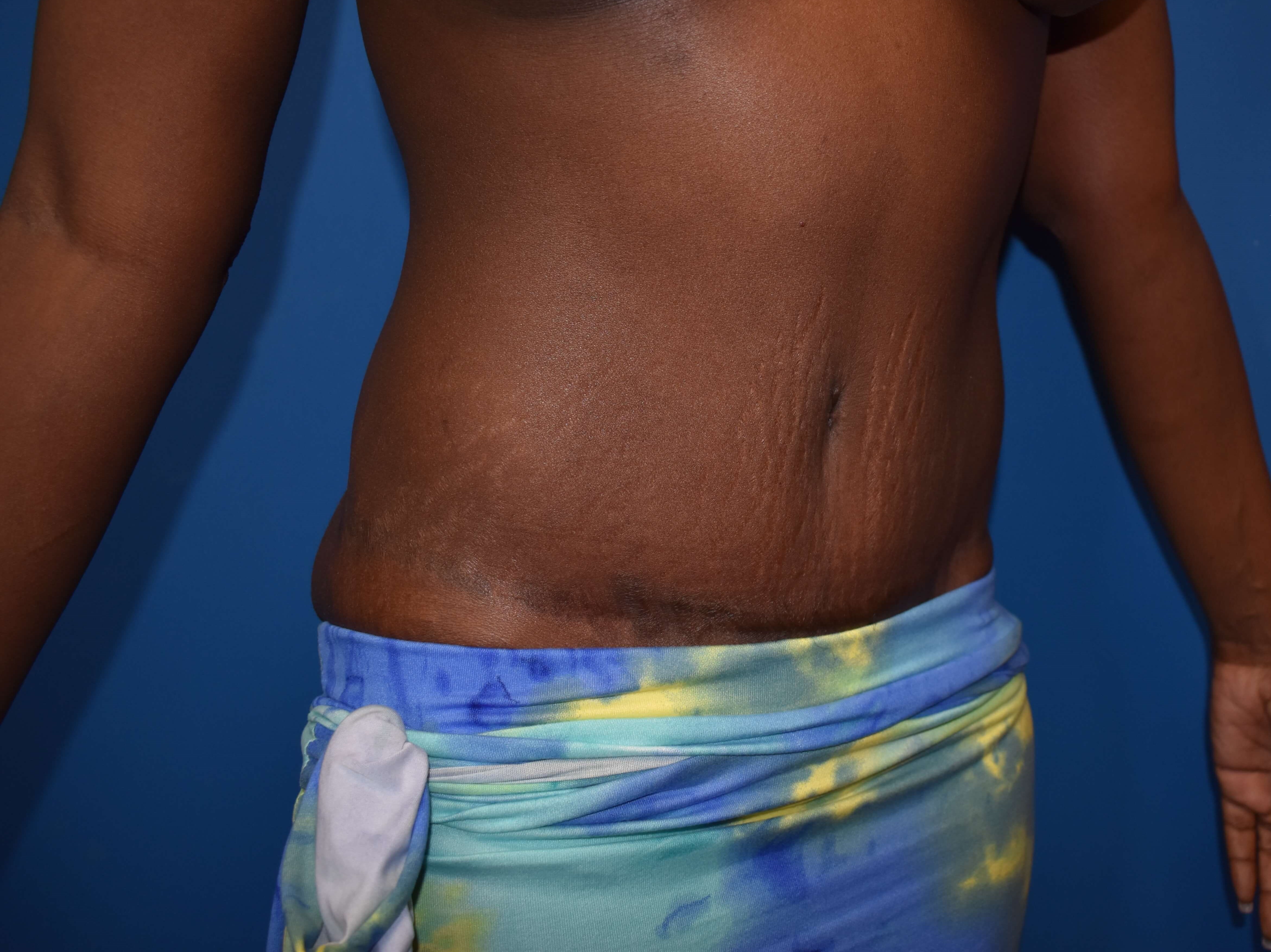 Oblique - Right After Lipoabdominoplasty