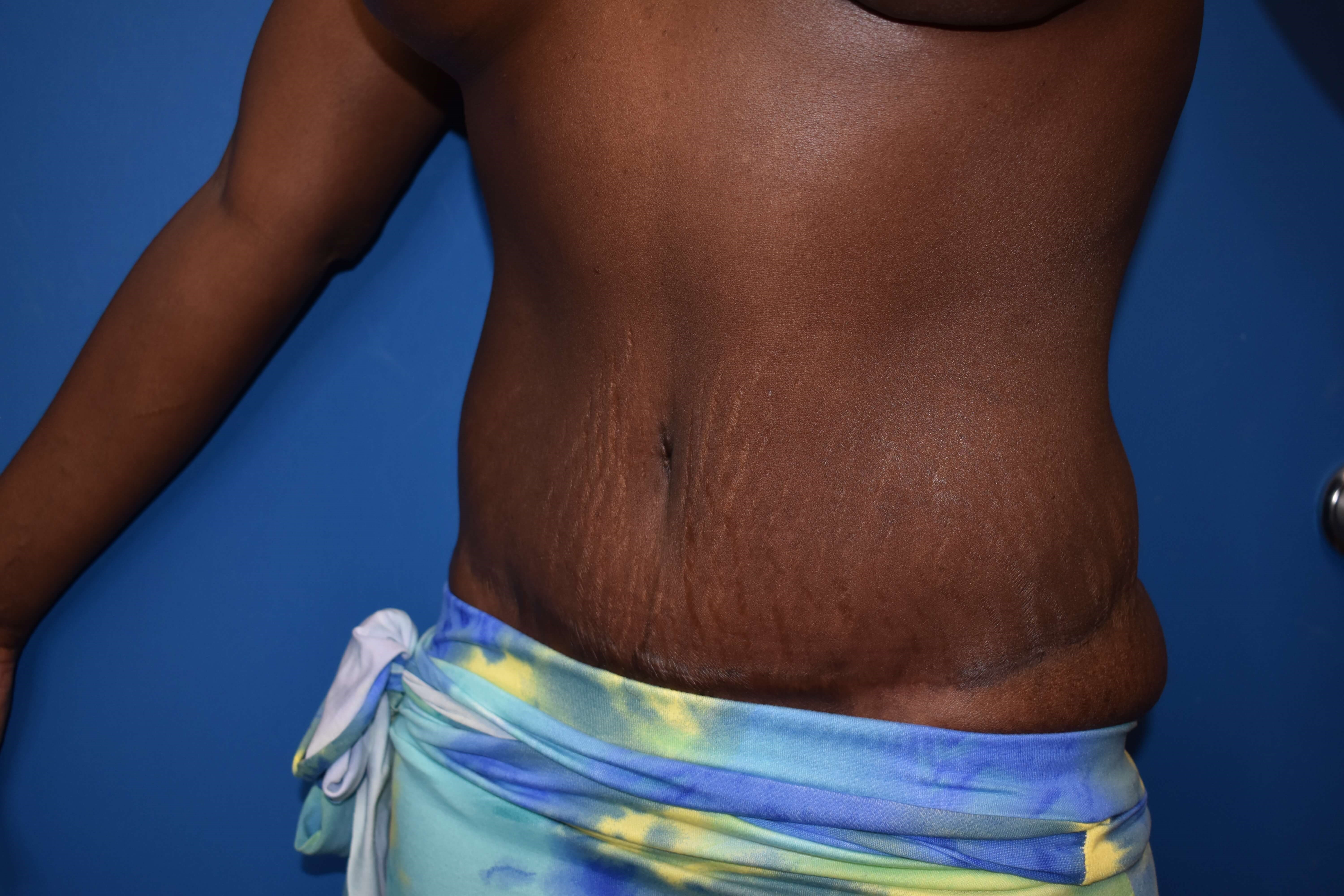 Oblique - Left After Lipoabdominoplasty