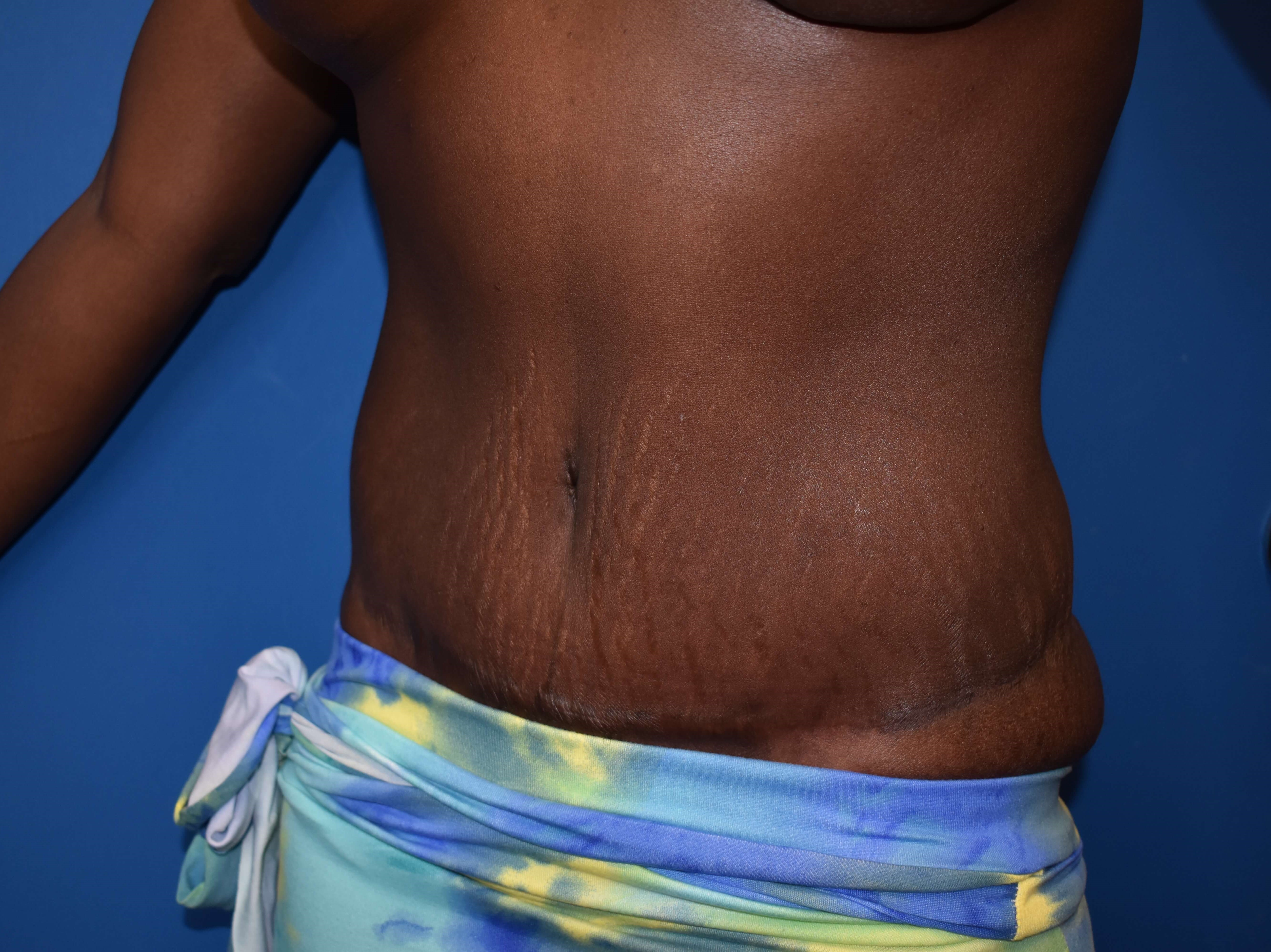 Oblique - Left After Lipoabdominoplasty