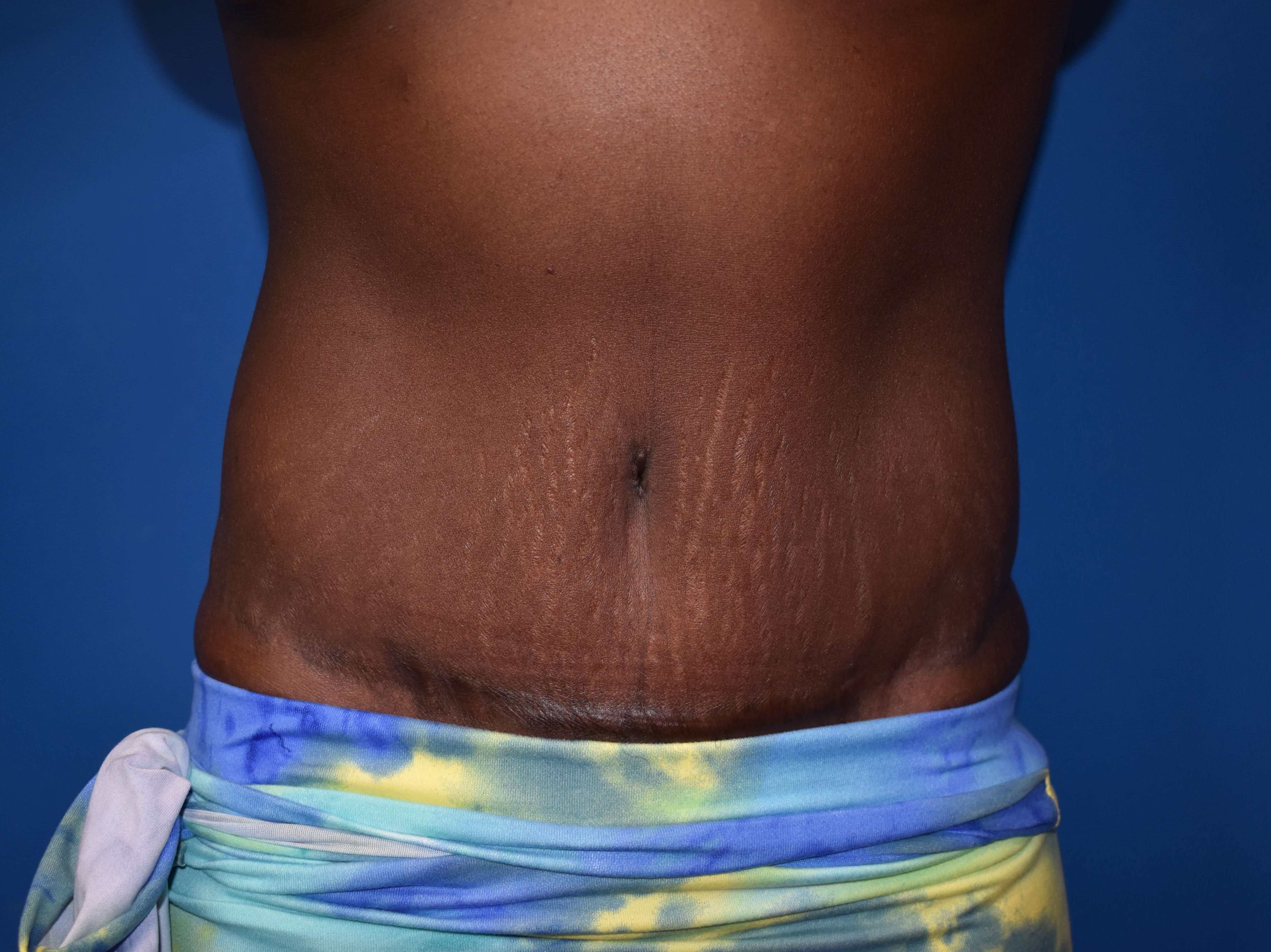 Front After Lipoabdominoplasty