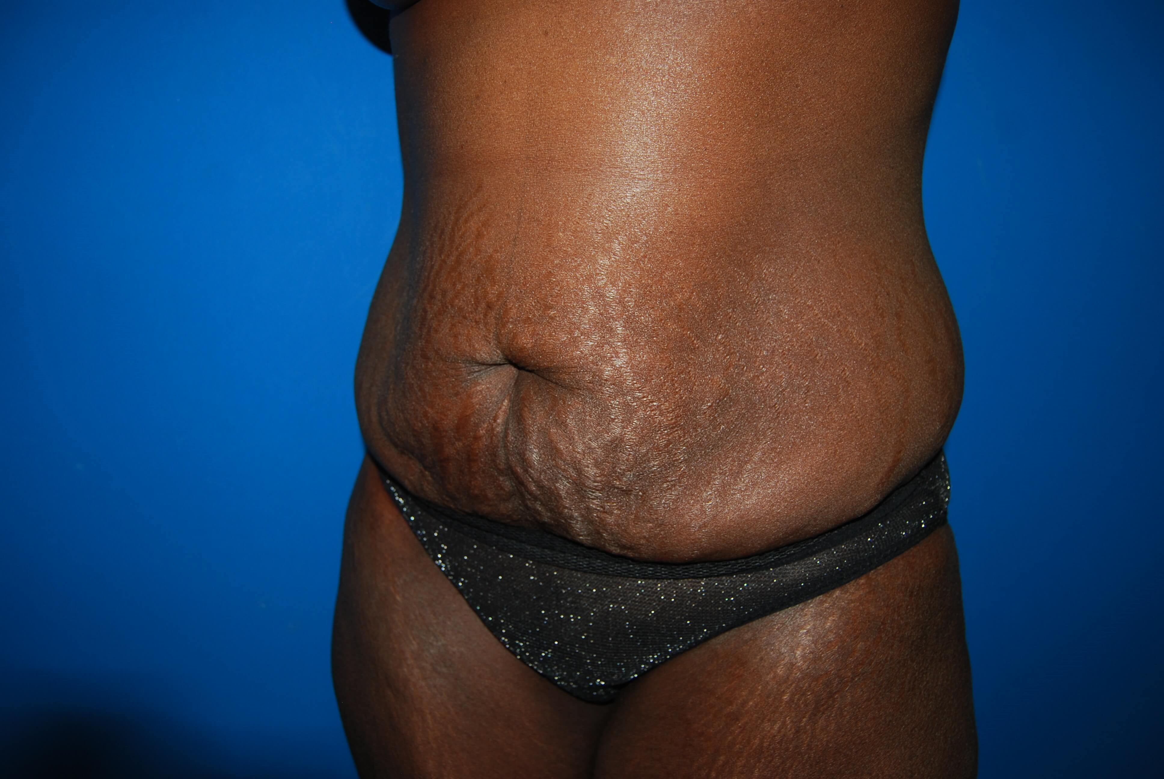 Oblique - Left Before Lipoabdominoplasty