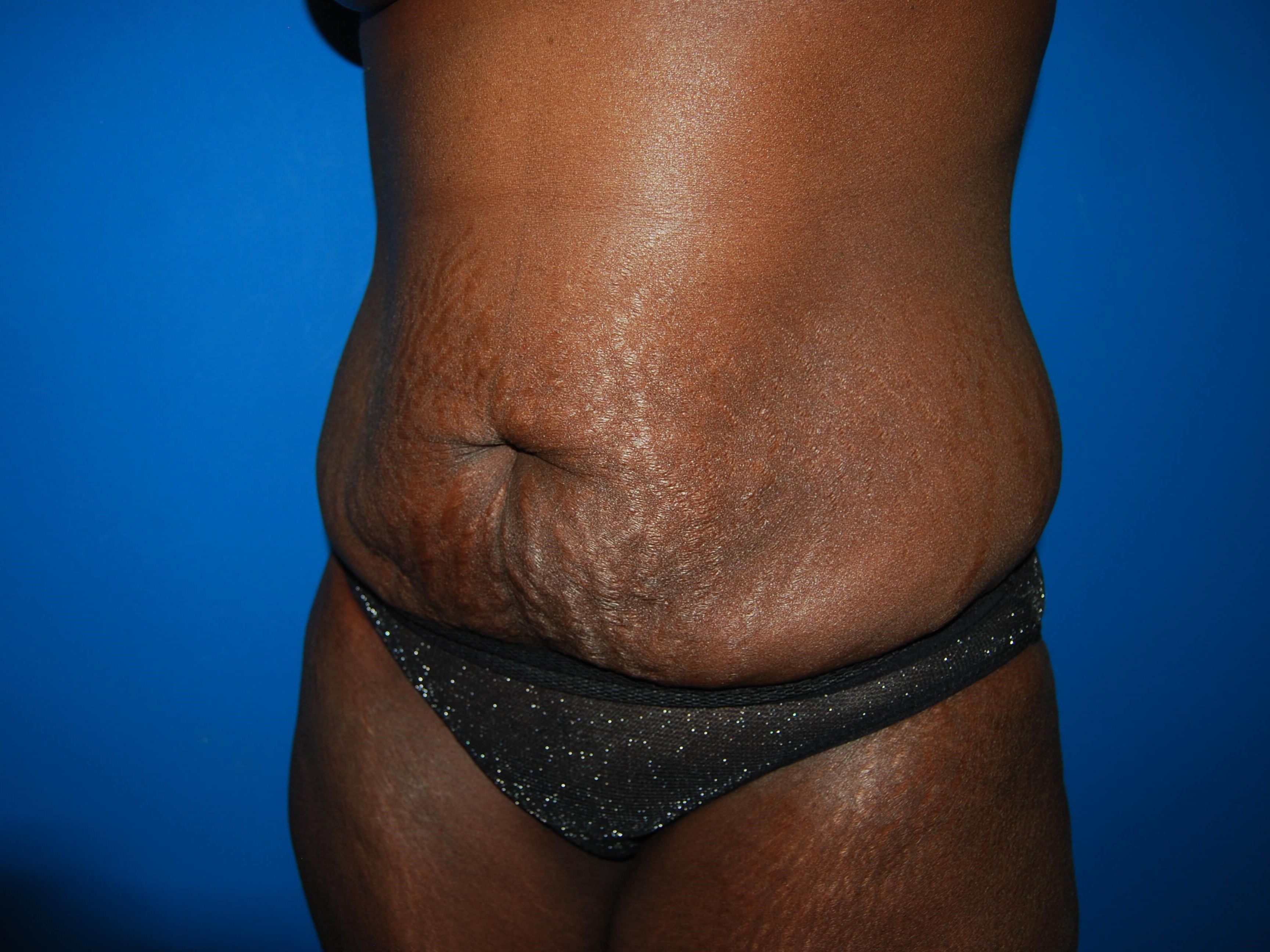 Oblique - Left Before Lipoabdominoplasty