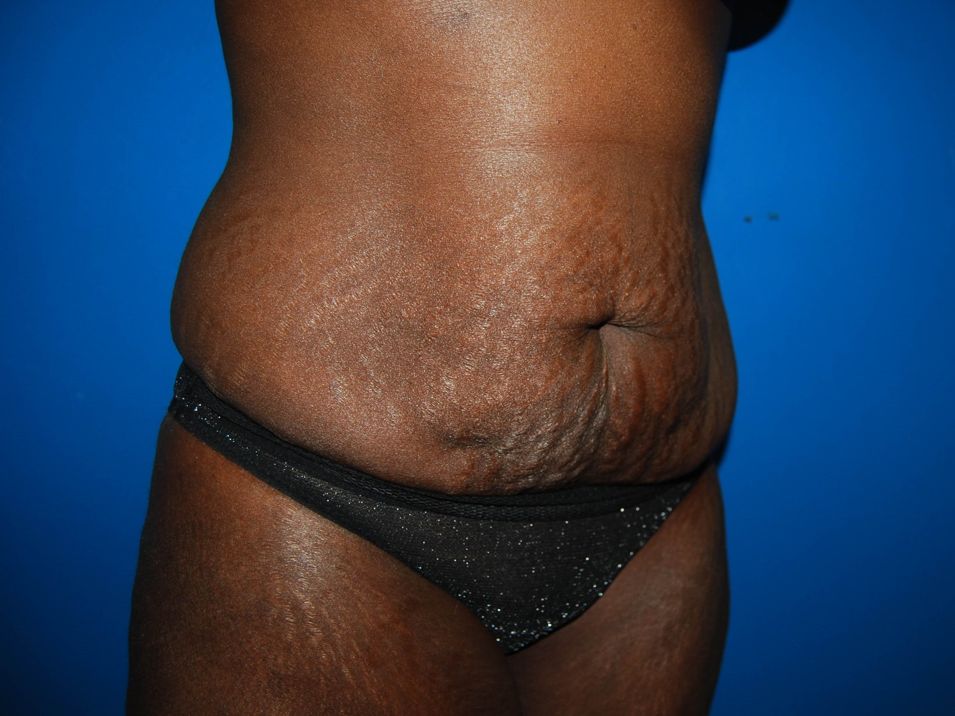 Oblique - Right Before Lipoabdominoplasty