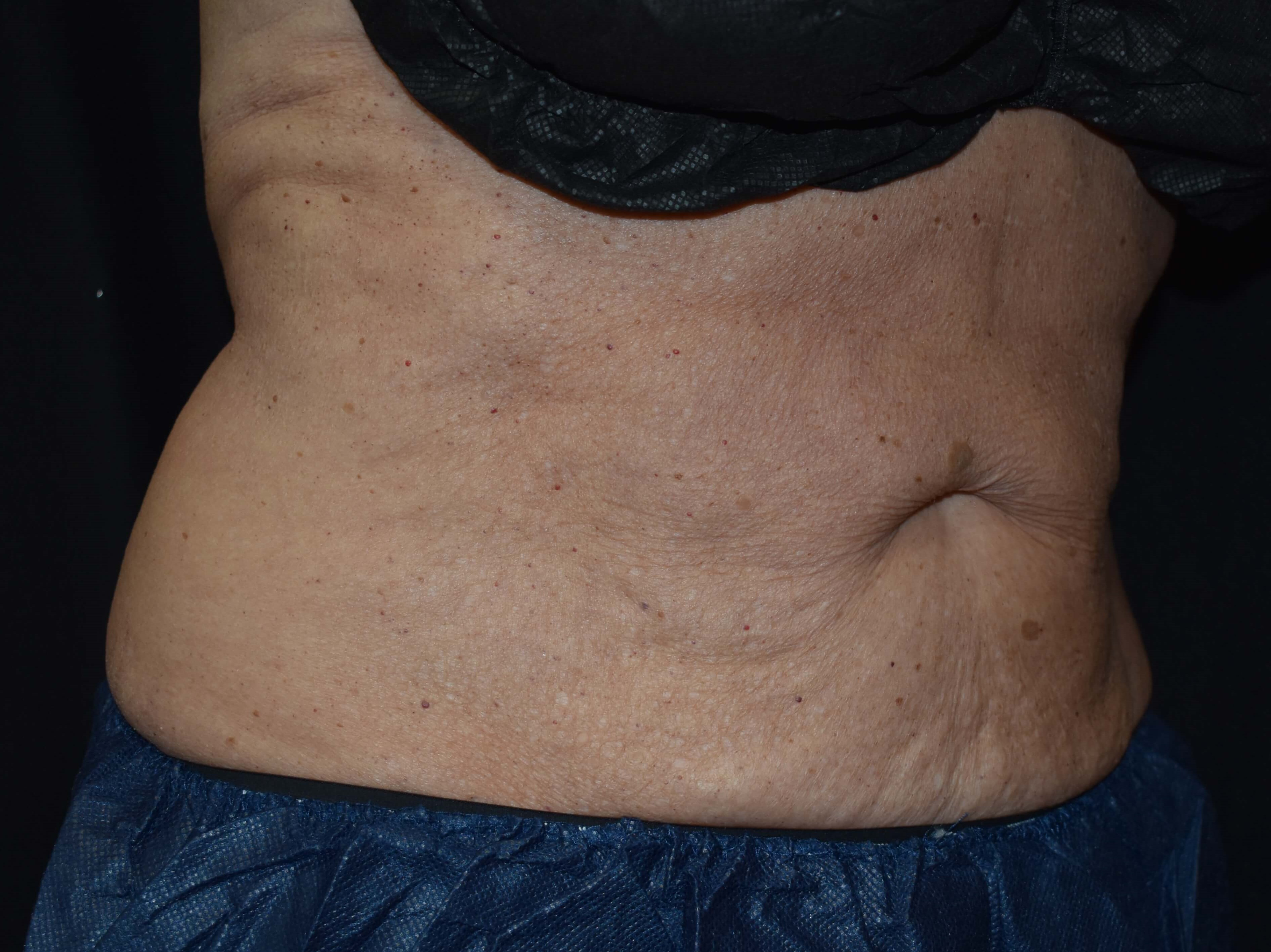 CoolSculpting Upper Abdomen After - CoolSculpting