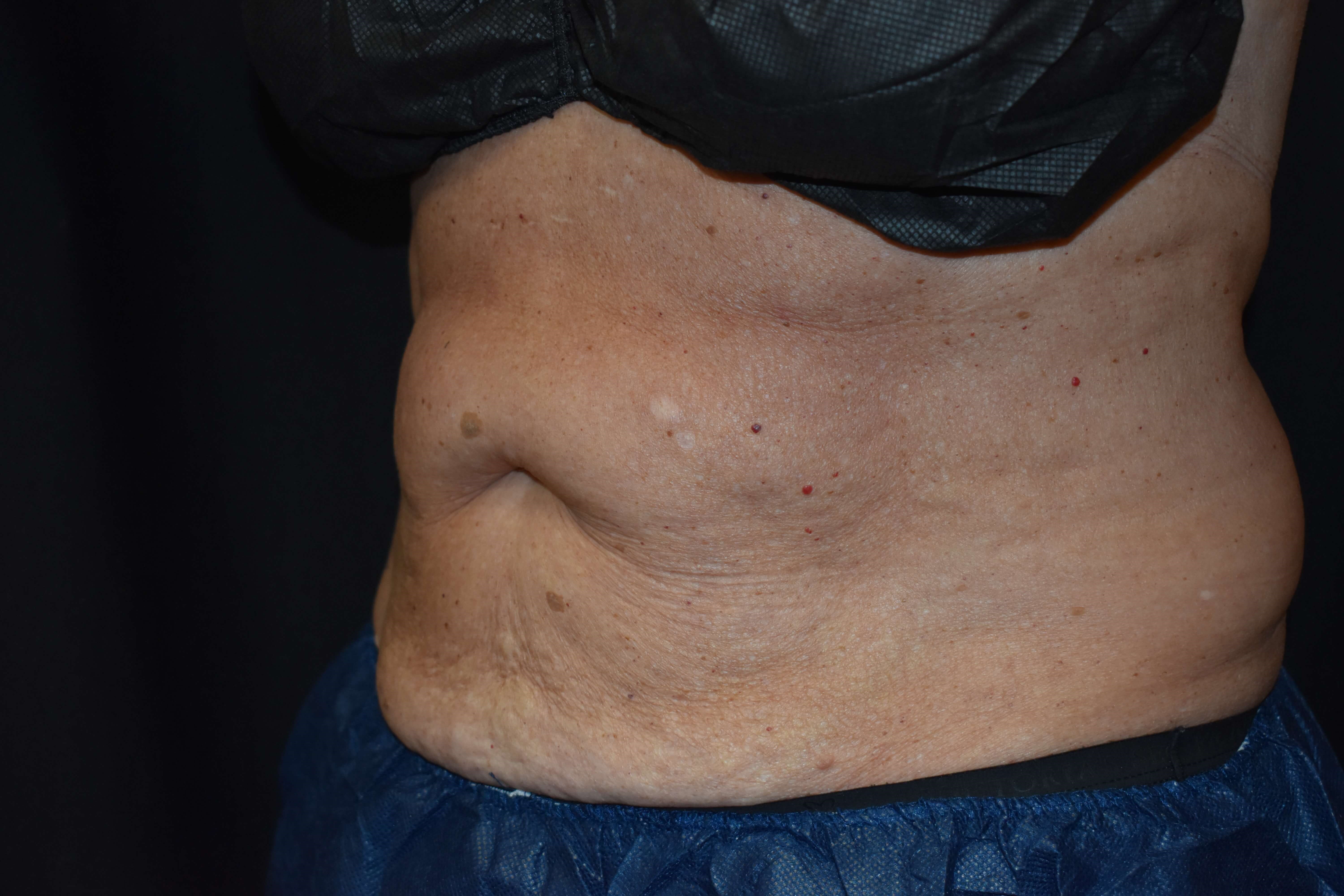 CoolSculpting Upper Abdomen Before- CoolSculpting