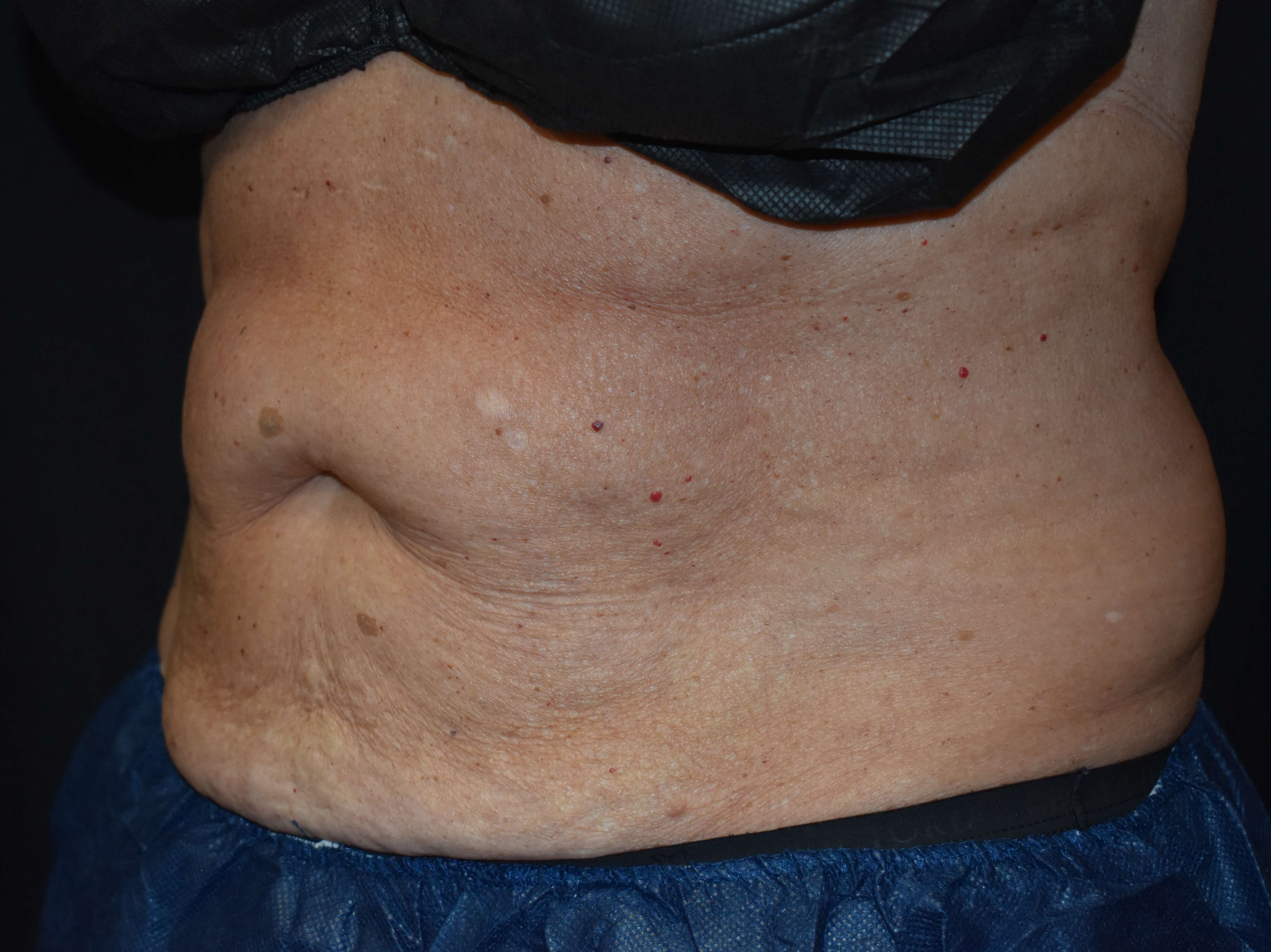 CoolSculpting Upper Abdomen Before- CoolSculpting