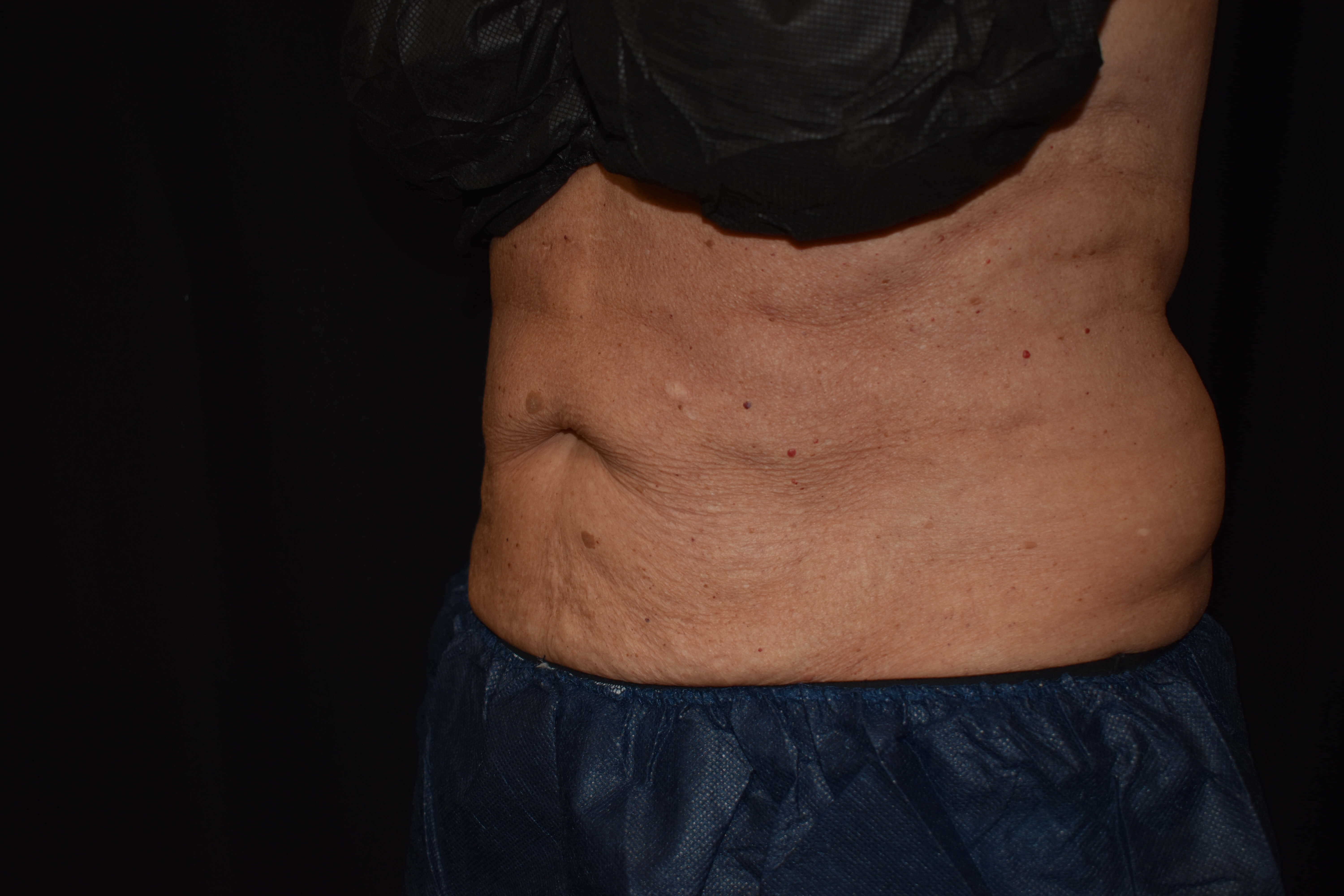 CoolSculpting Upper Abdomen After - CoolSculpting
