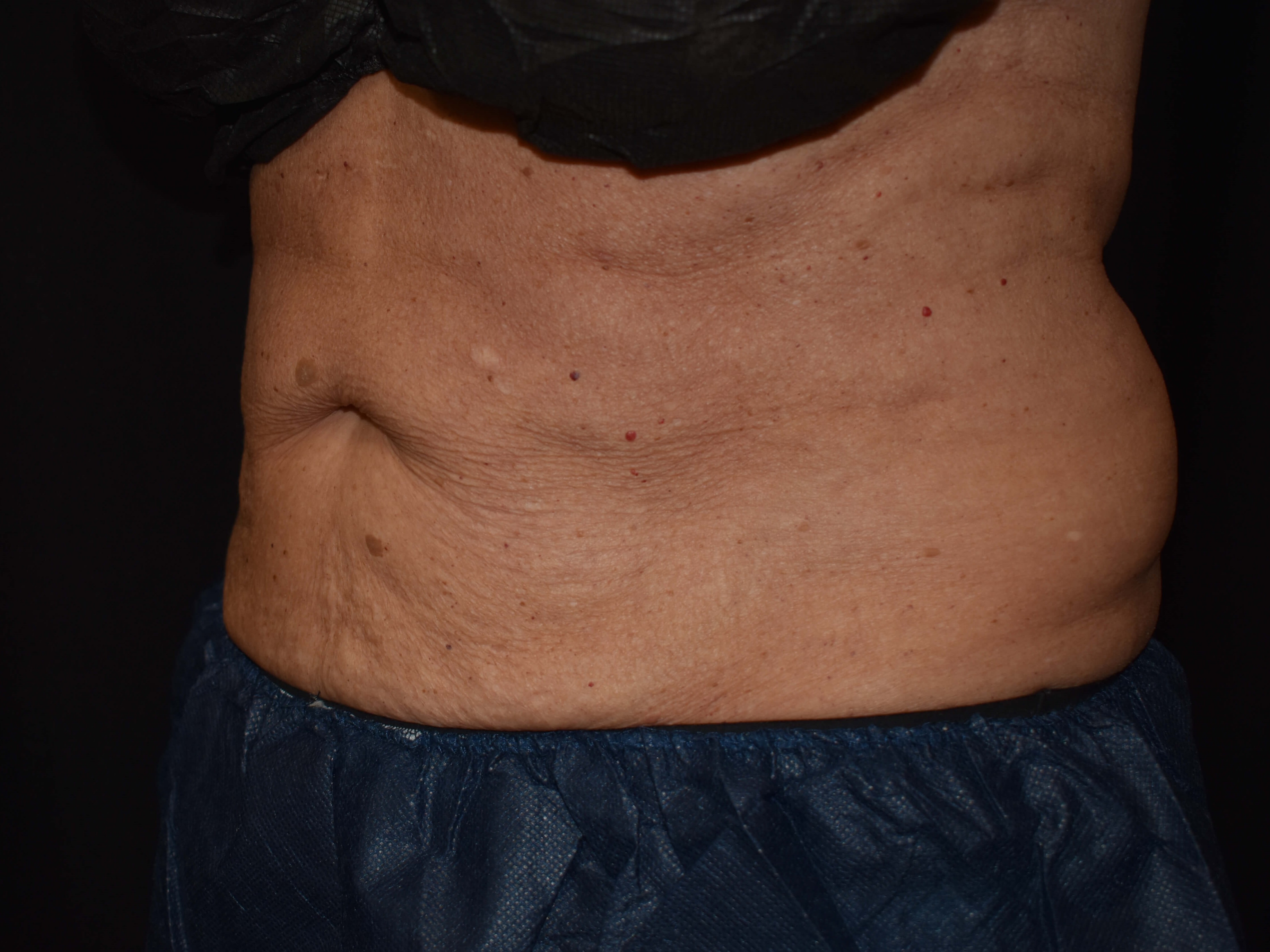 CoolSculpting Upper Abdomen After - CoolSculpting