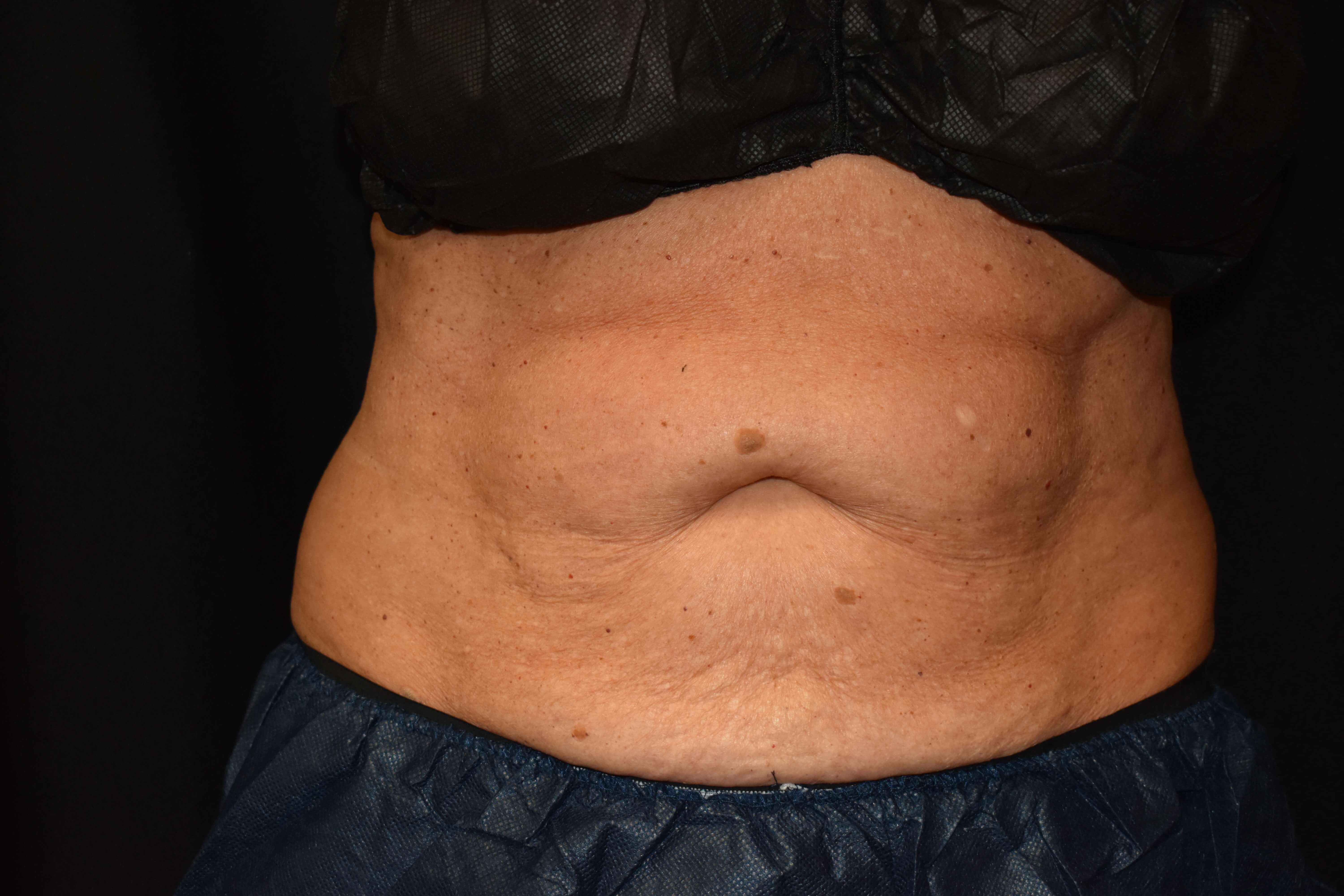 CoolSculpting Upper Abdomen Before - CoolSculpting
