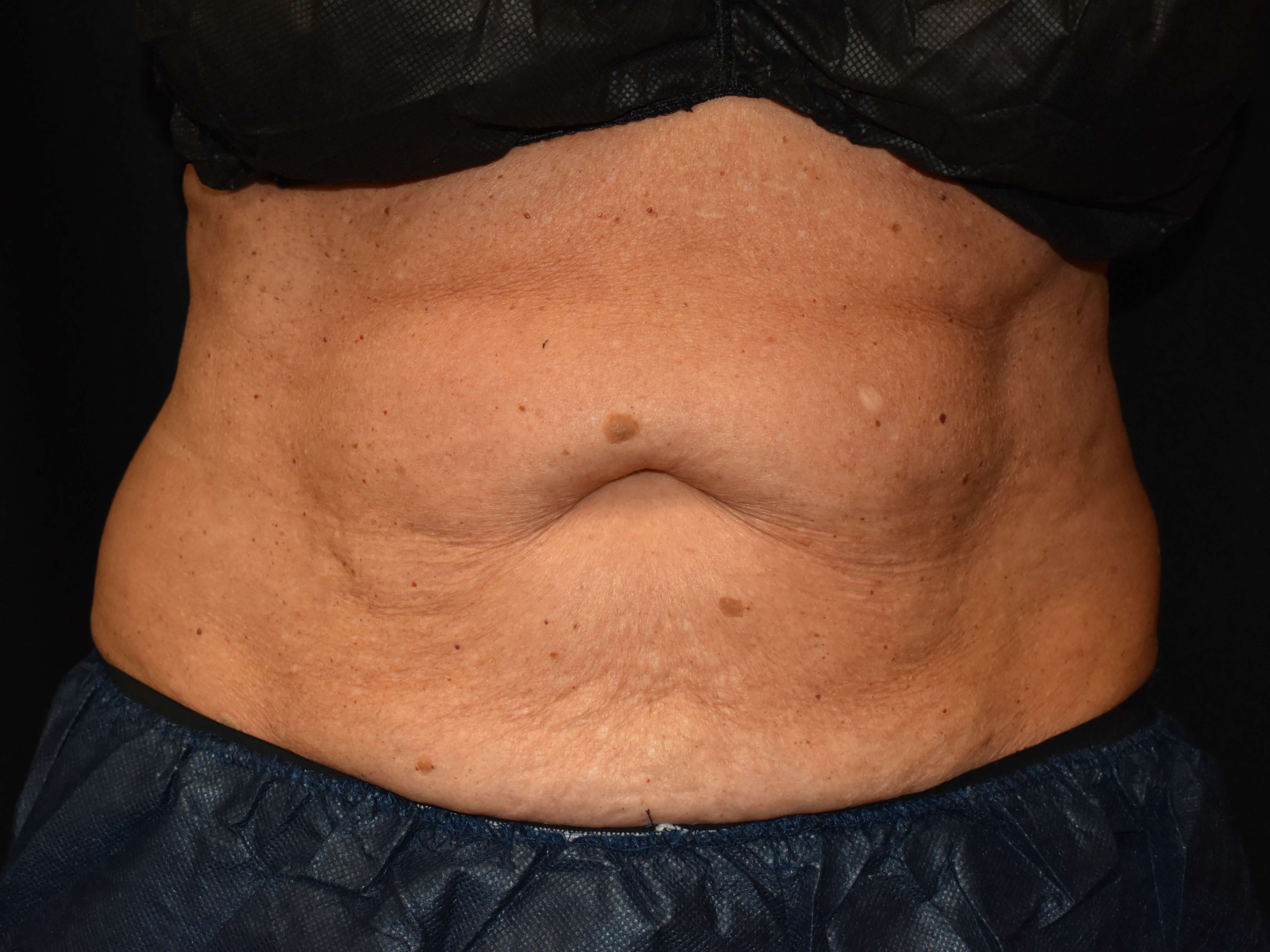 CoolSculpting Upper Abdomen Before - CoolSculpting