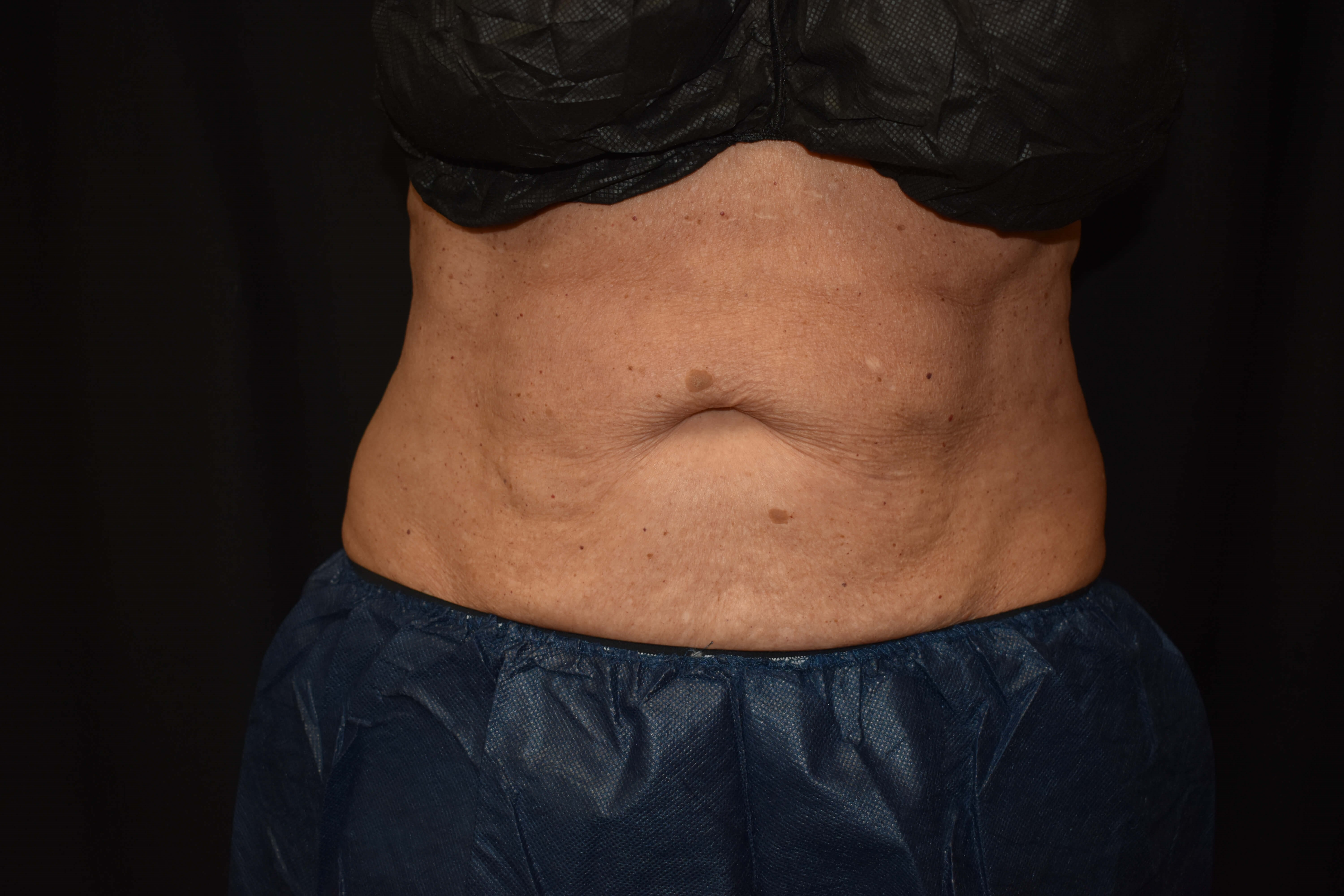 CoolSculpting Upper Abdomen After - CoolSculpting