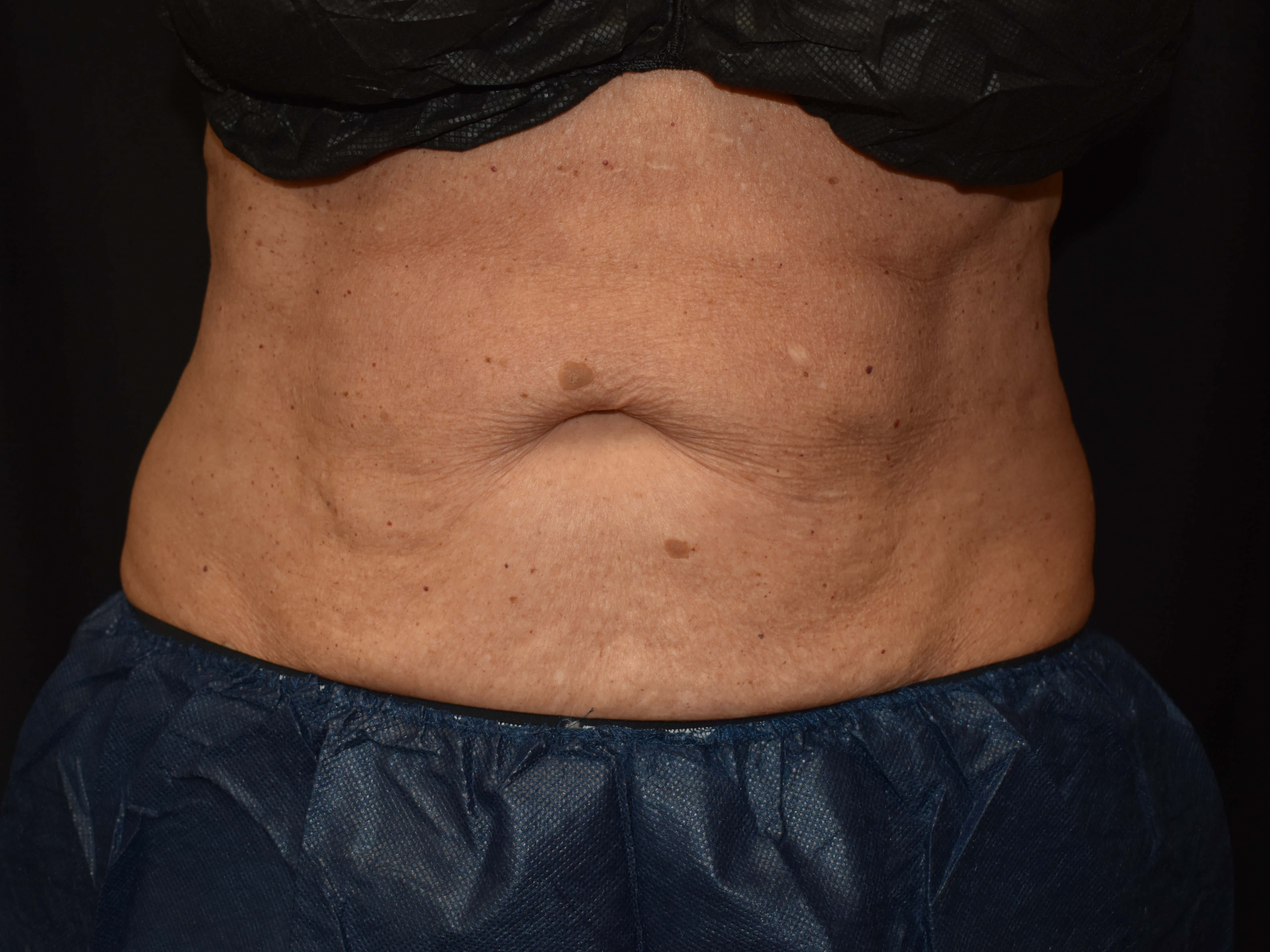CoolSculpting Upper Abdomen After - CoolSculpting