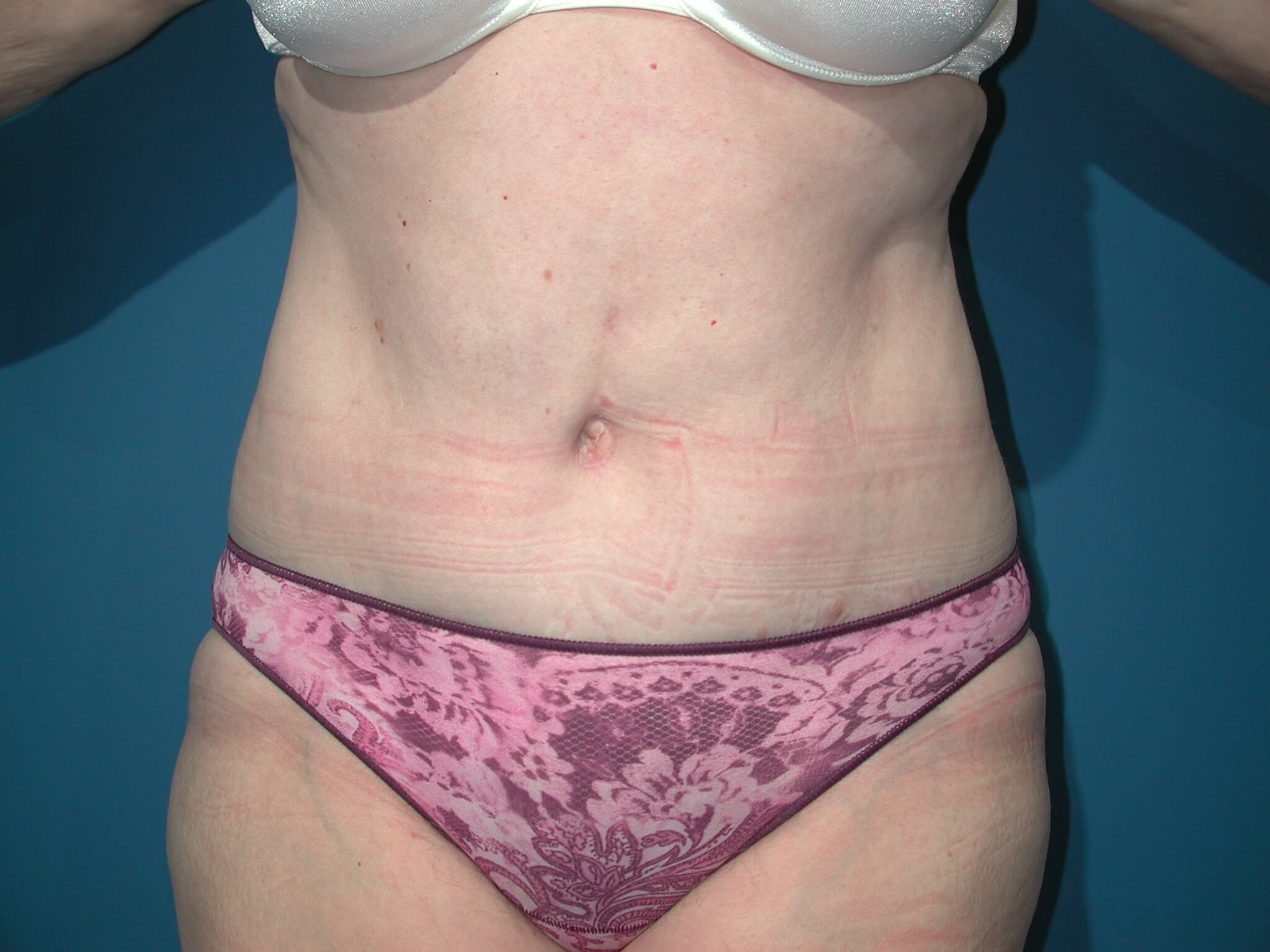 Front After Abdominoplasty