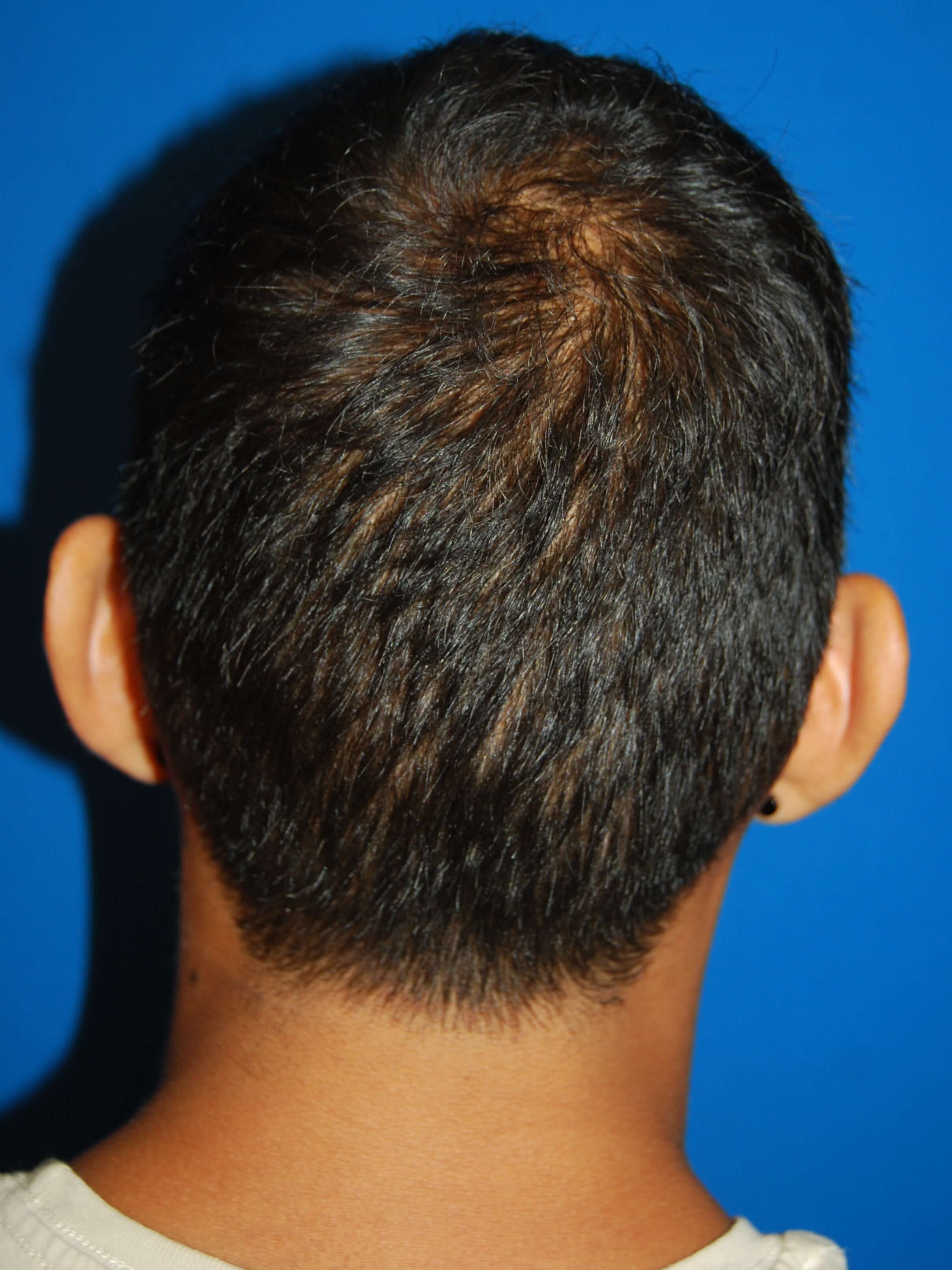 Back View Before Otoplasty
