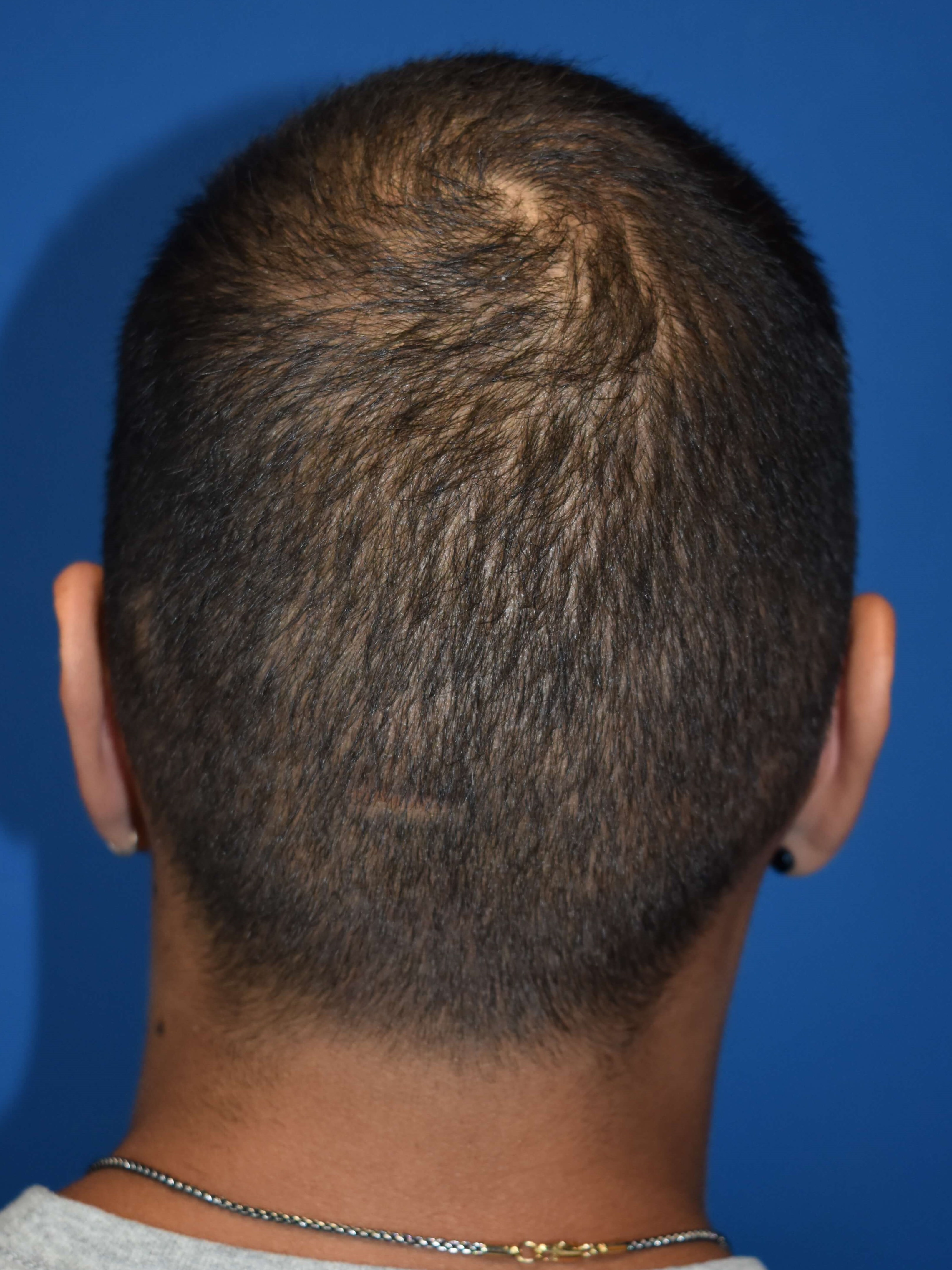 Back View After Otoplasty