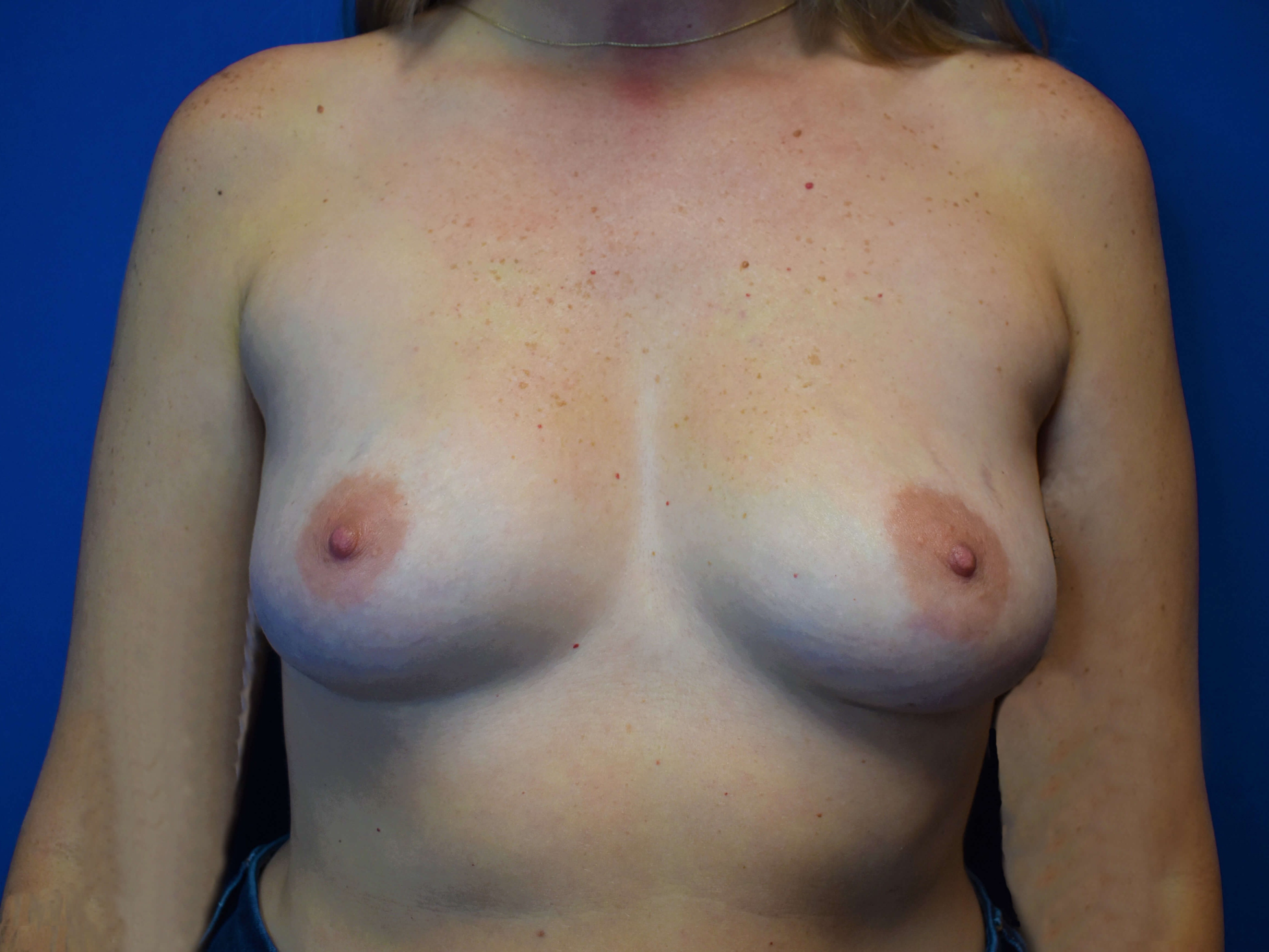 Front Before Breast Augmentation