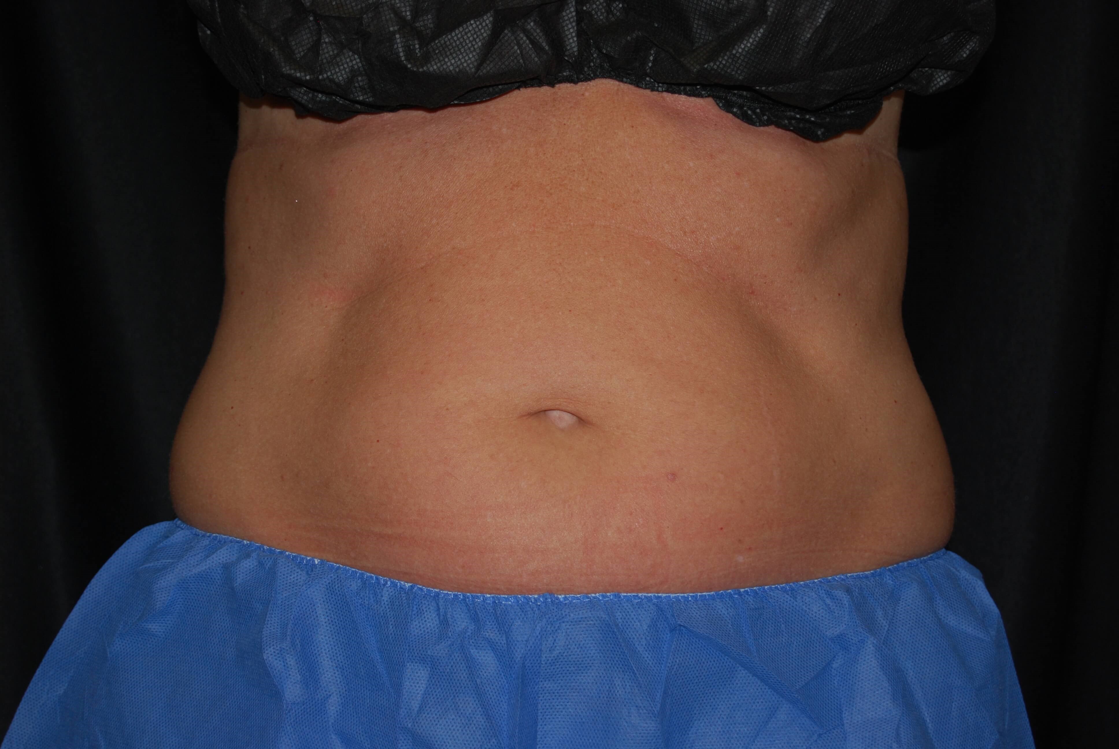 Coolsculpting - abdomen Before Coolsculpting