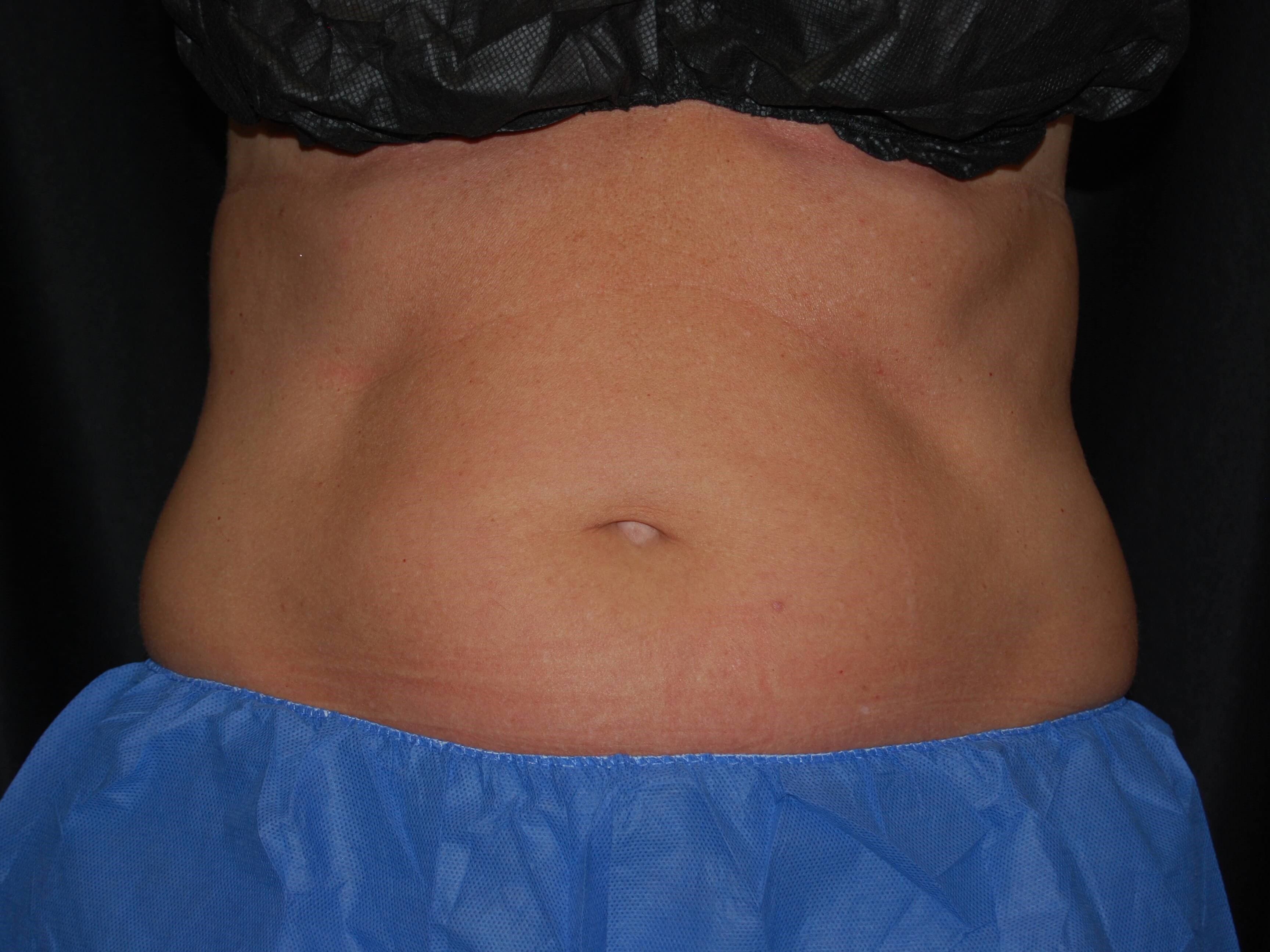 Coolsculpting - abdomen Before Coolsculpting