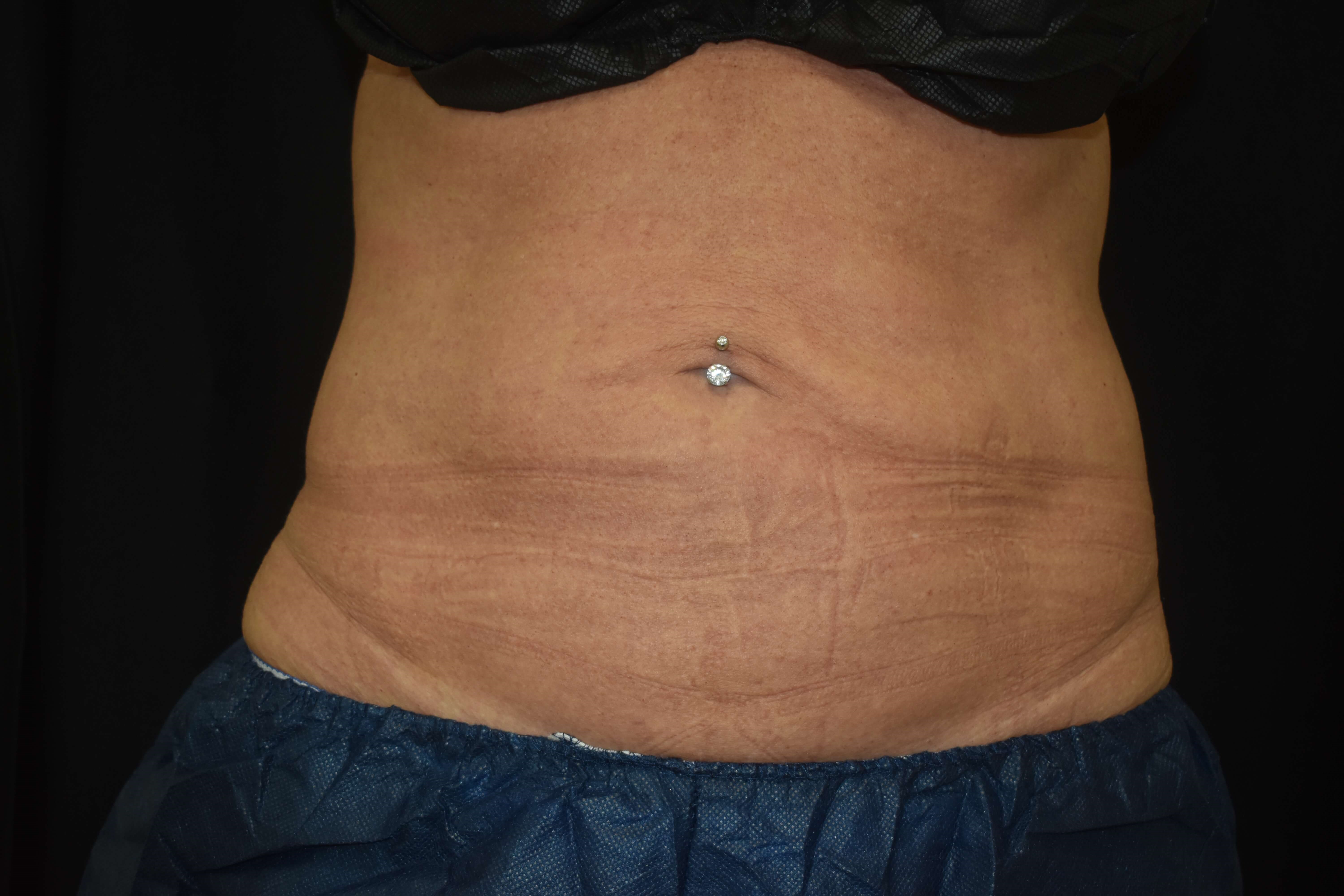 Coolsculpting - abdomen After Coolsculpting