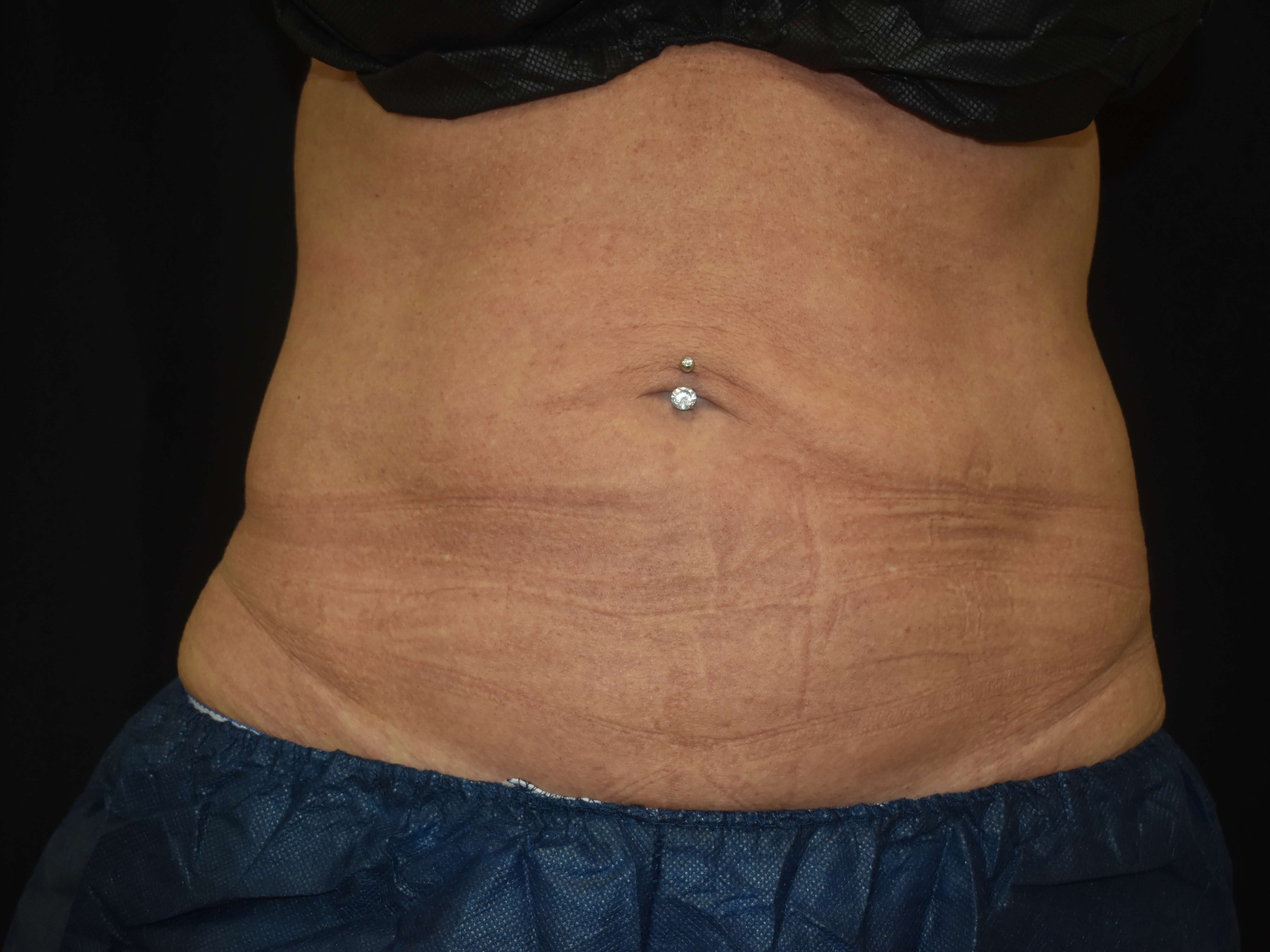 Coolsculpting - abdomen After Coolsculpting