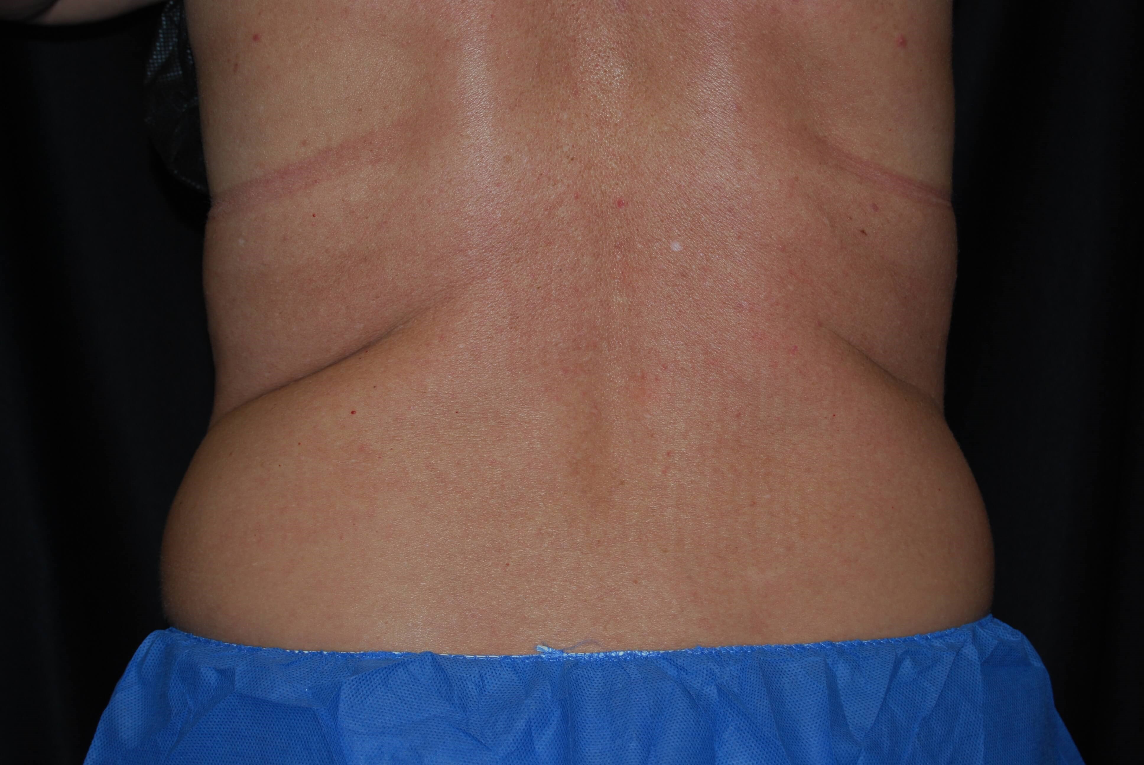 Coolsculpting - Flanks Before