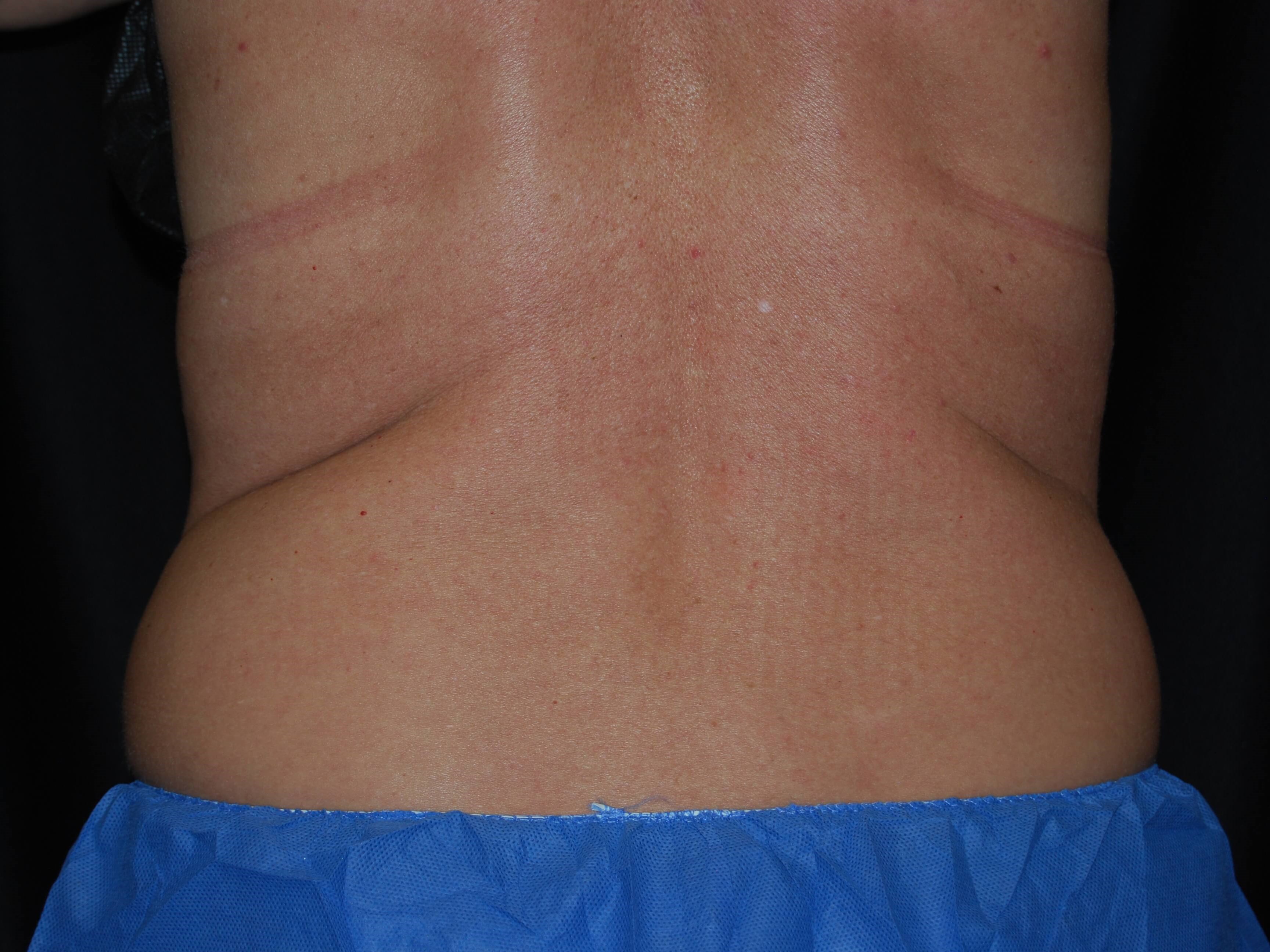 Coolsculpting - Flanks Before
