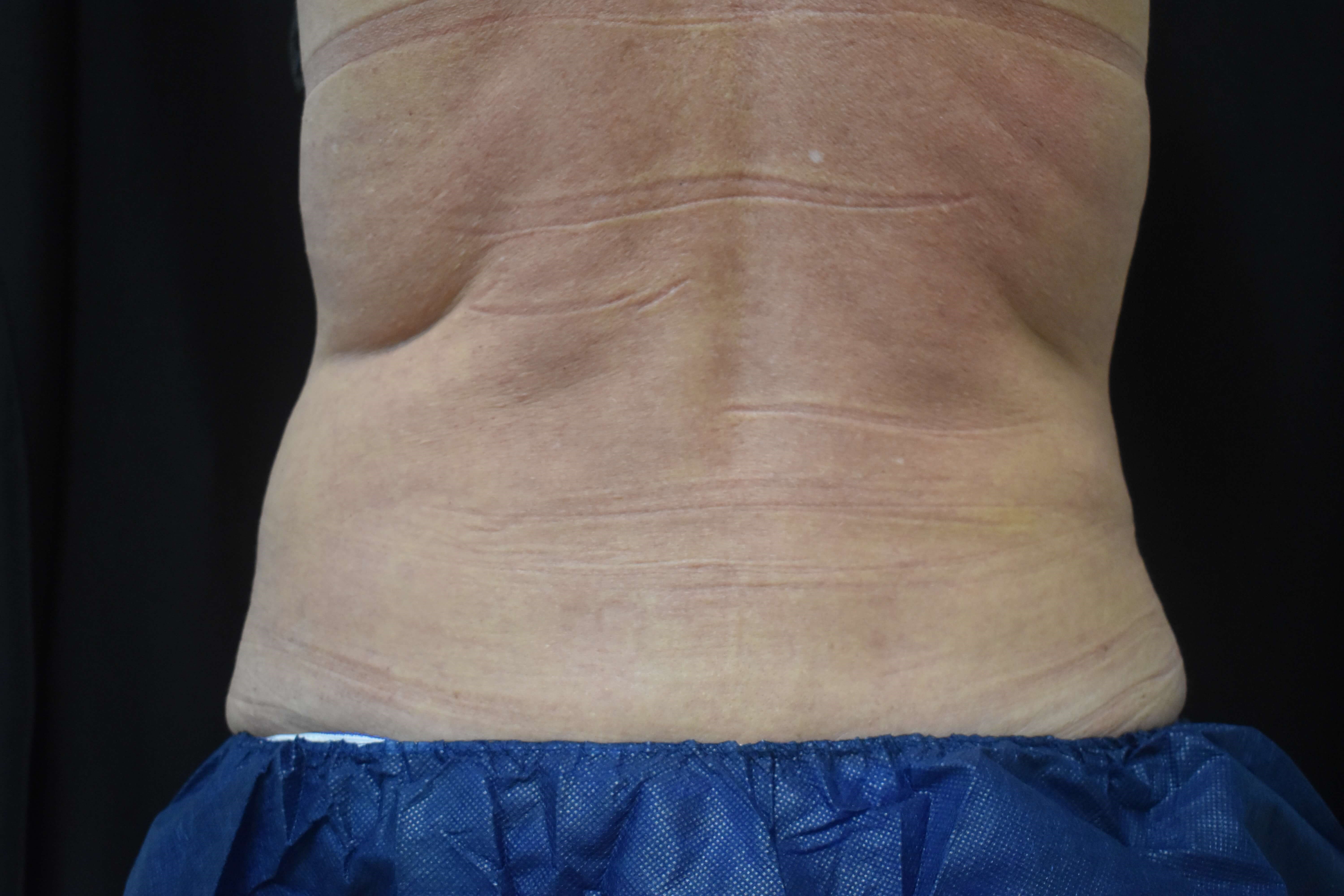 Coolsculpting - Flanks After