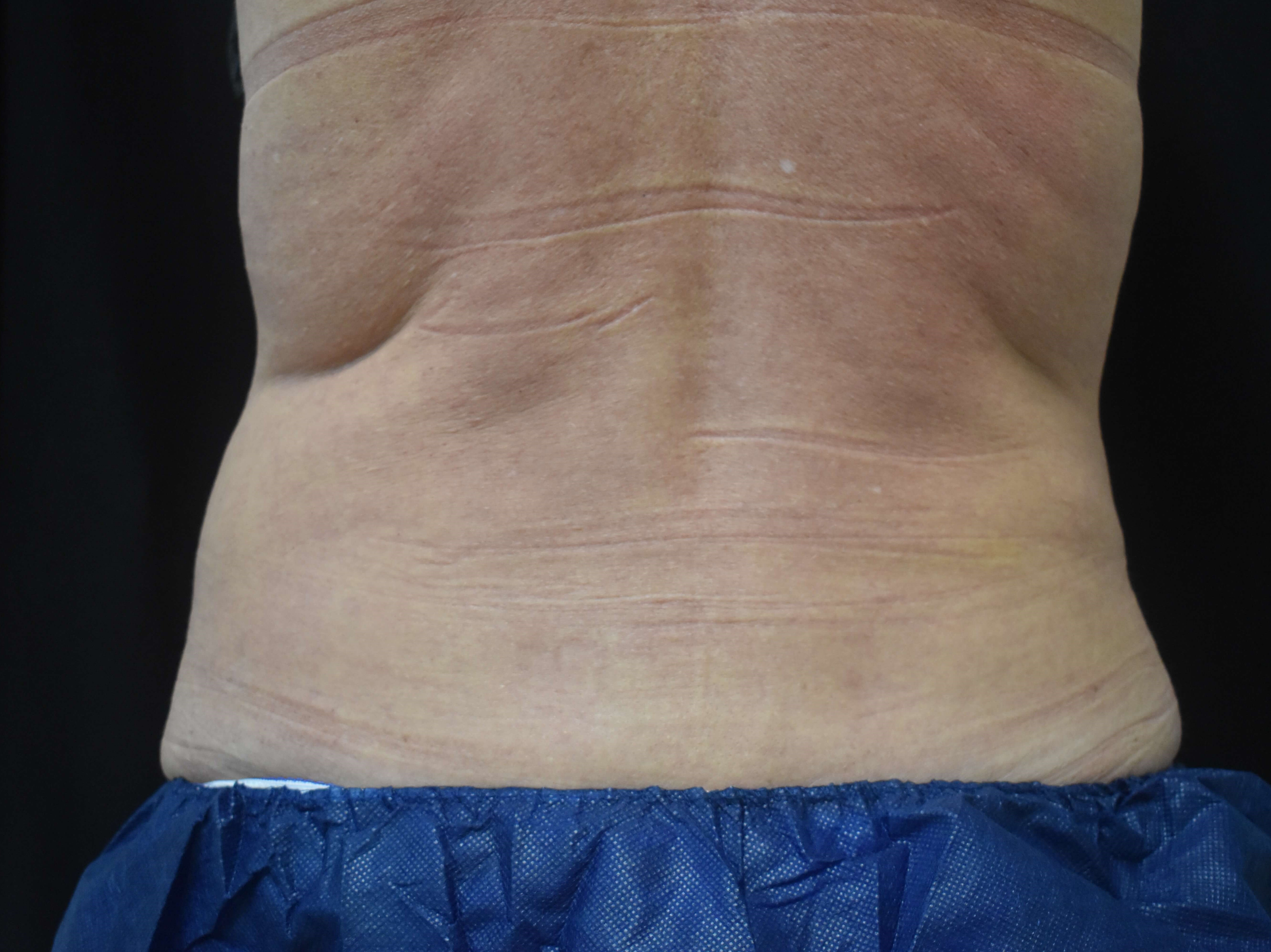 Coolsculpting - Flanks After